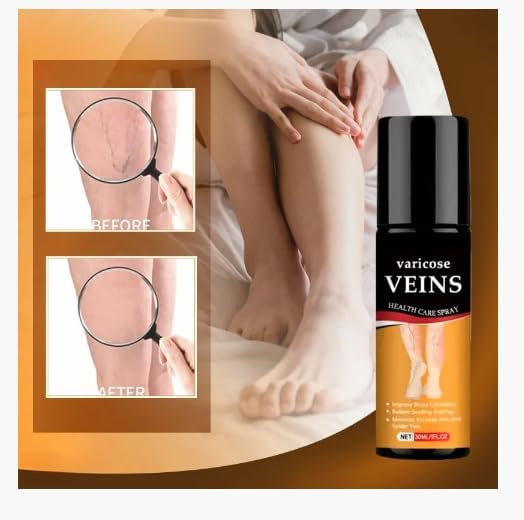 Varicose Care Herbal Calming Spray at Just 499/-