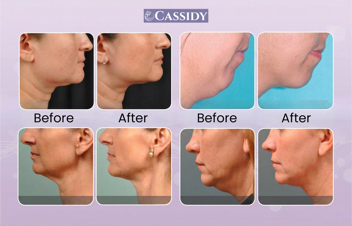 YouthLift Pro Neck Cream – Lift & Sculpt At Just 499/-