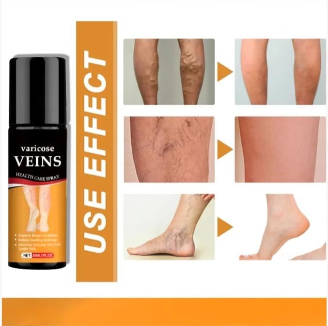 Varicose Care Herbal Calming Spray at Just 499/-
