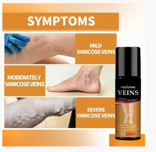 Varicose Care Herbal Calming Spray at Just 499/-